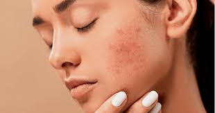 Top 7 Skin Problems That Need a Dermatologist (Not Just Home Remedies)