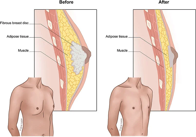 Gynecomastia in Men: Causes, Treatments & Permanent Solutions