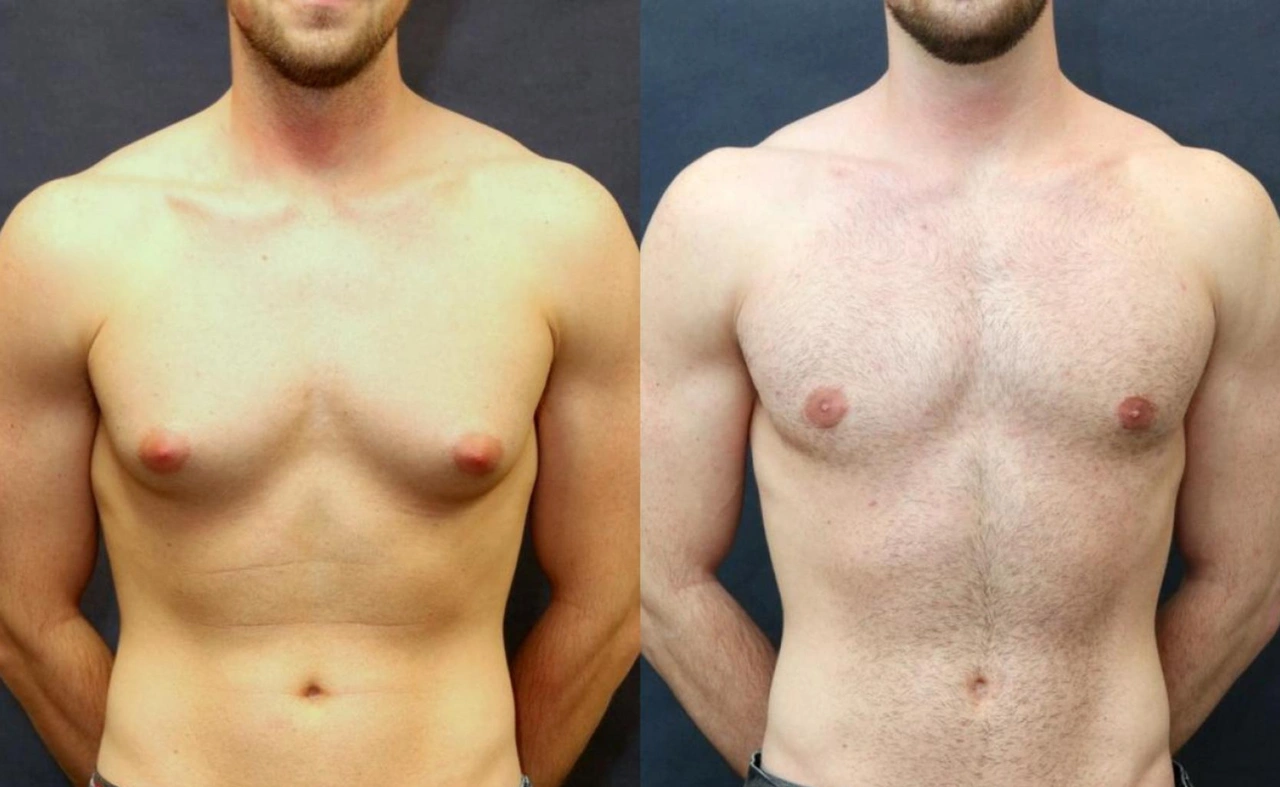 Gynecomastia in Men: Causes, Treatments & Permanent Solutions