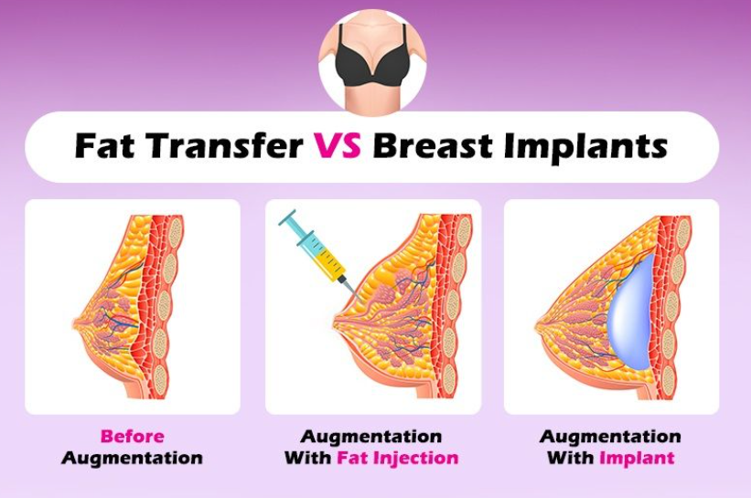 Fat Grafting vs. Implants: Which Breast Enhancement Option Is Best for You?