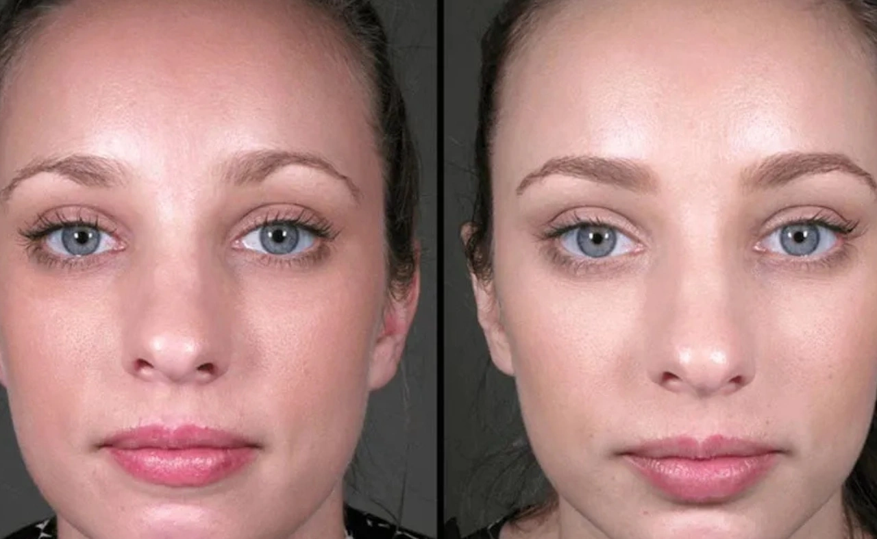 Facelift vs. Non-Surgical Facial Rejuvenation: Which Works Better for Aging?