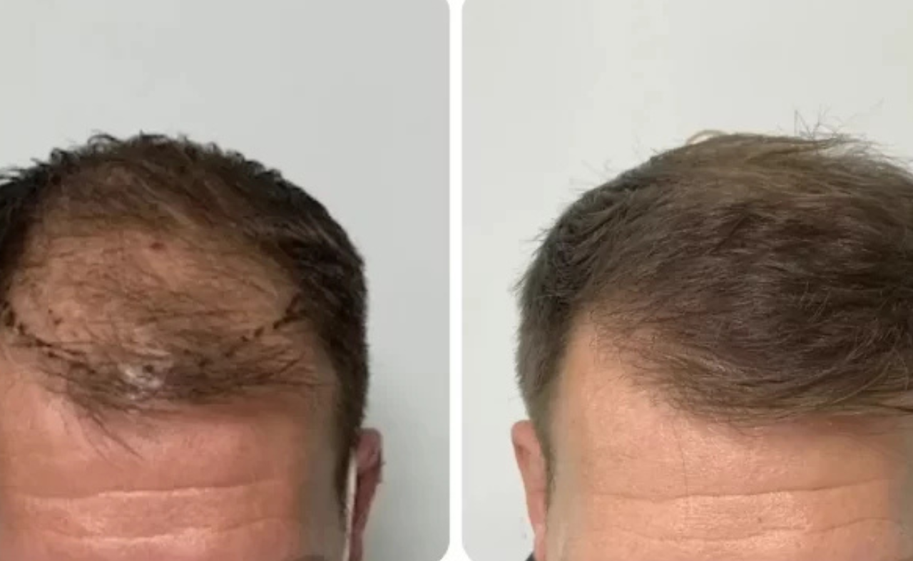 Hair Transplant Recovery Timeline: Week by Week Results Explained