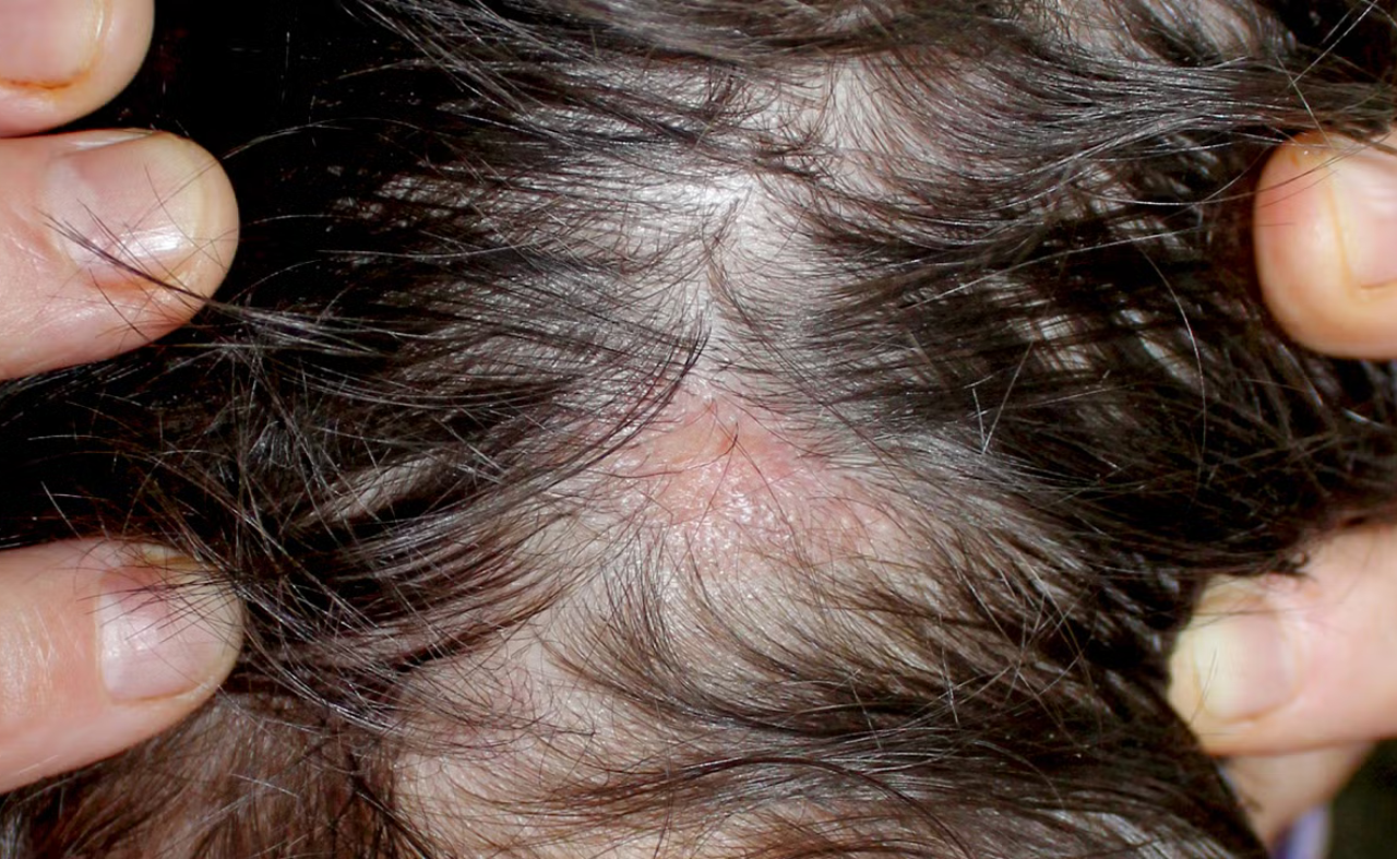Top 5 Causes of Hair Loss and When to See a Hair Specialist Doctor