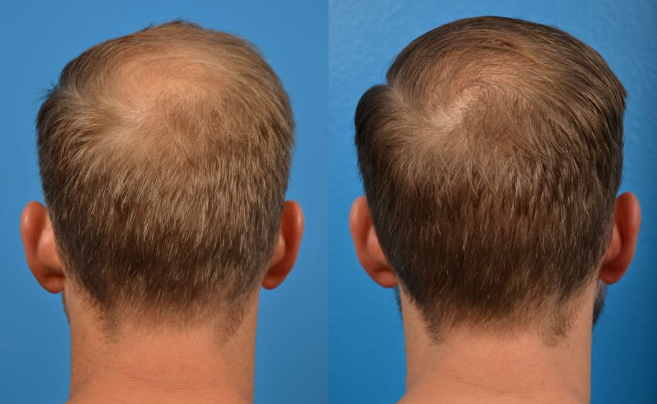 Autologous Stem Cell-derived Therapies for Hair Restoration