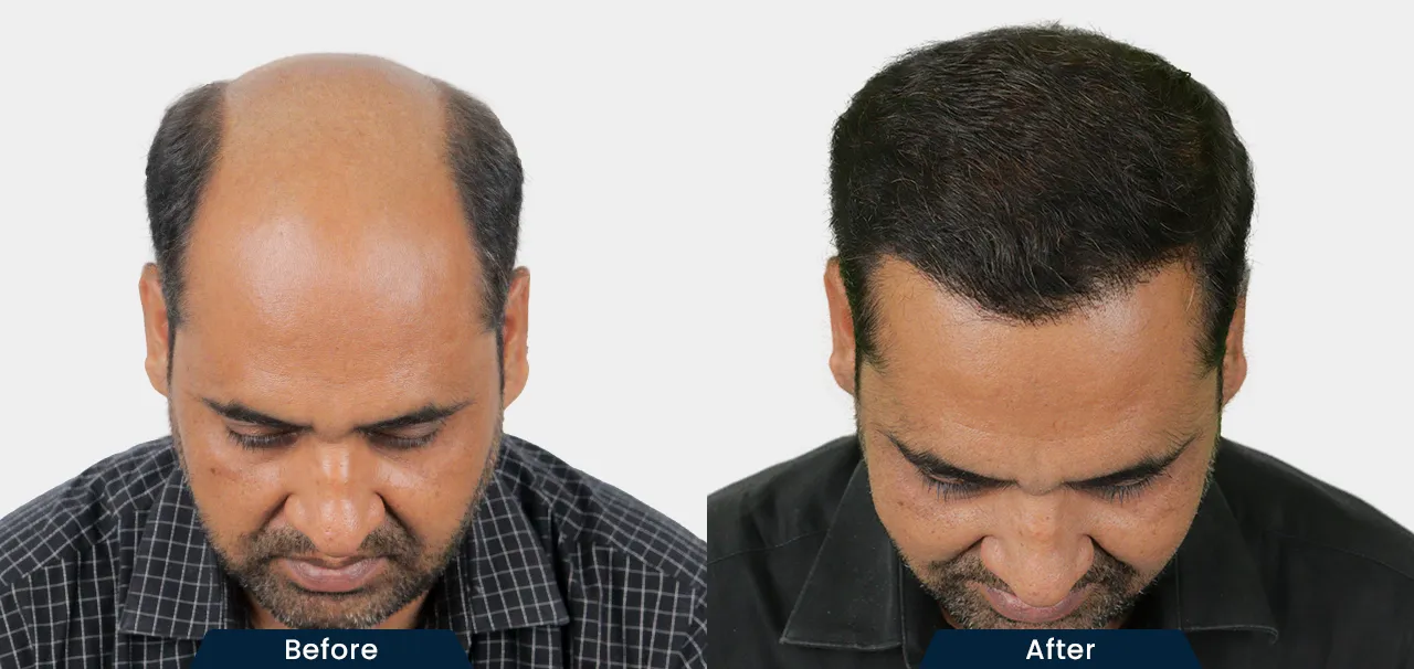 Best Hair Transplant Clinic in Ahmedabad: How to Choose the Right Surgeon