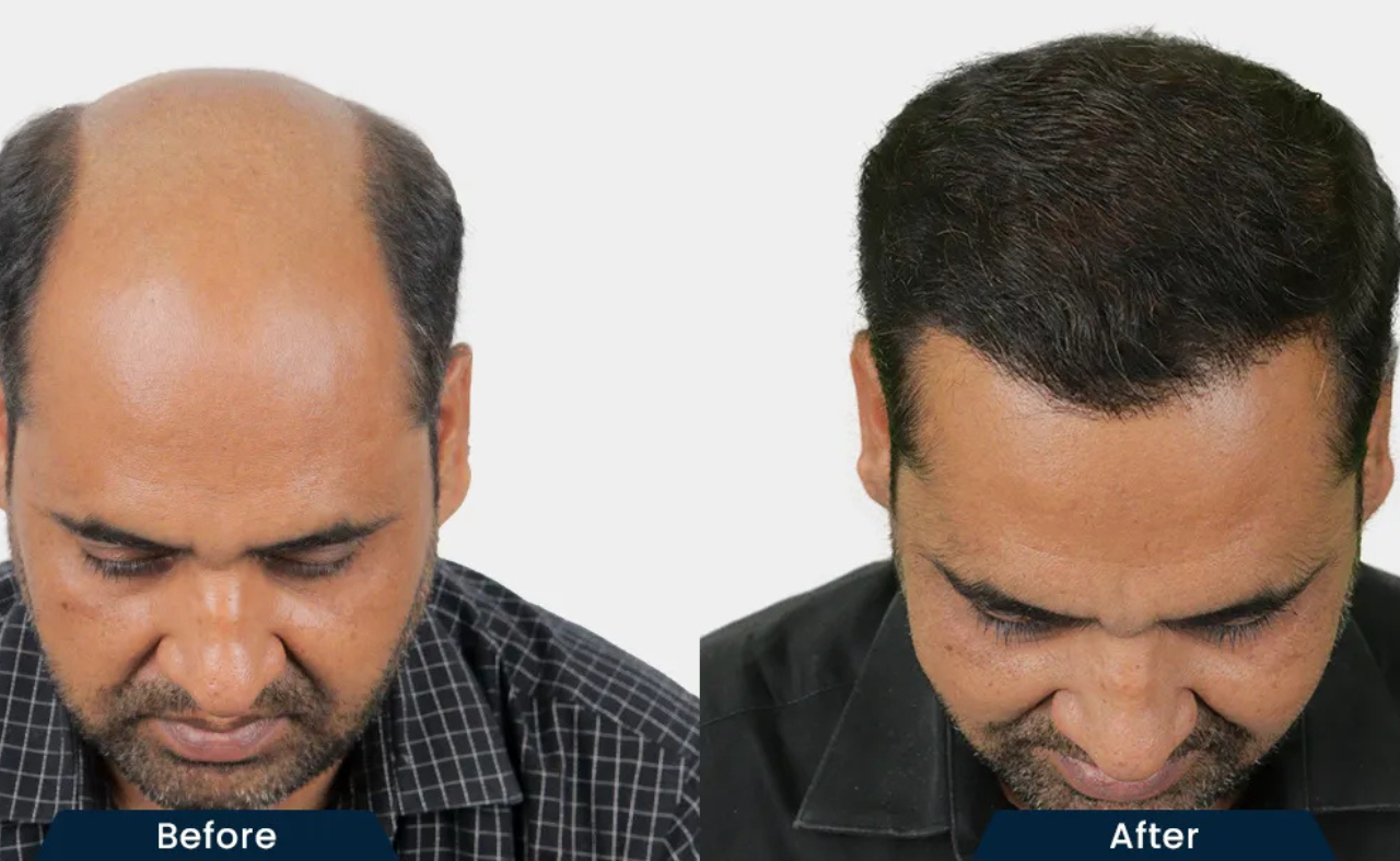 Best Hair Transplant Clinic in Ahmedabad: How to Choose the Right Surgeon