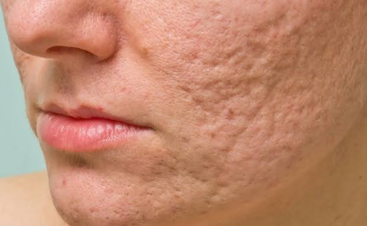 Best Dermatologist in Ahmedabad for Acne, Pigmentation & Hair Loss