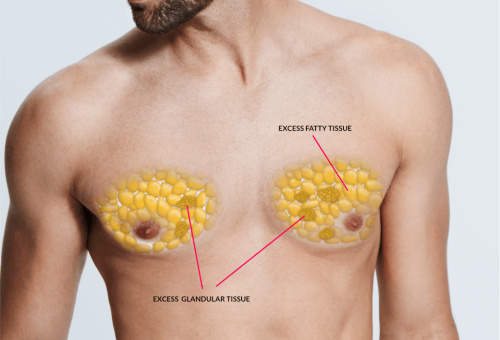 5a321ac2fd7b9d00016be824_gynecomastia 5a321ac2fd7b9d00016be824_gynecomastia