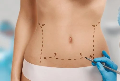 Abdominoplasty (Tummy Tuck)