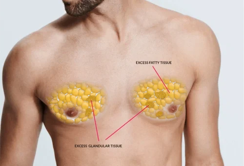 Gynecomastia Treatment