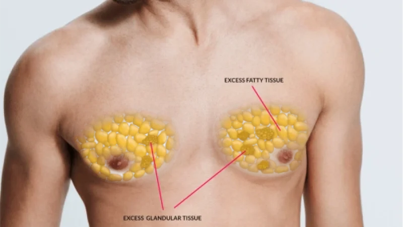 Gynecomastia Treatment