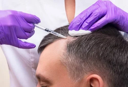 Hair Transplant