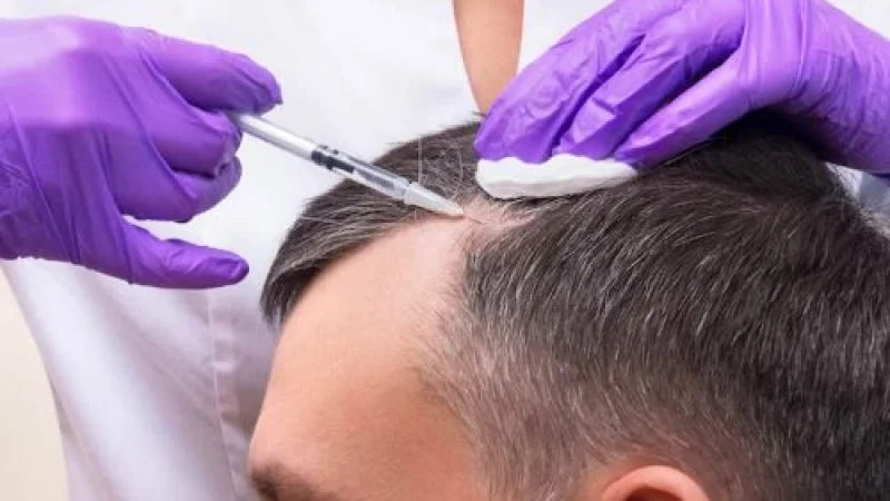 Hair Transplant