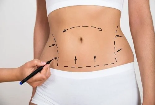 Liposuction