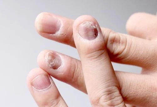Nail-Diseases-1024x597-1-r41mbhcnr7jjfrgmr44i81l99dh9rmwwq3nwokca4o