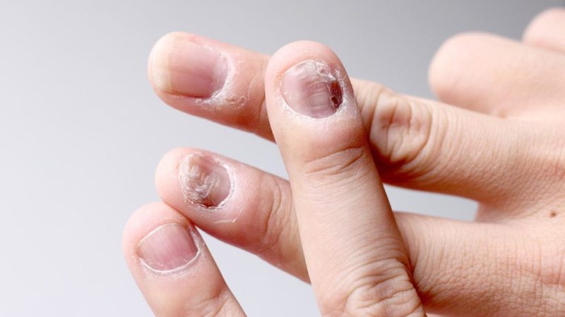 Nail-Diseases-1024×597 Nail-Diseases-1024x597