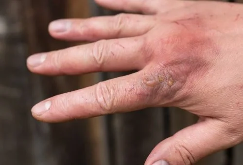 Post Burn Deformity Correction