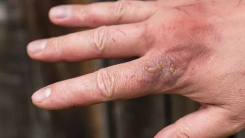 Post Burn Deformity Correction