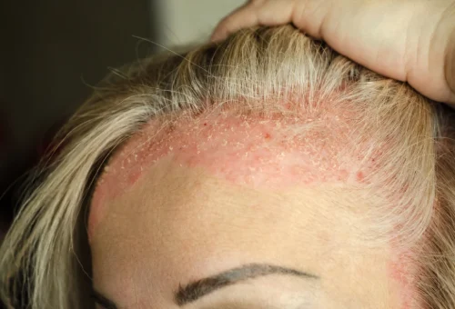 Scalp-Psoriasis-Symptoms-Treatments Scalp-Psoriasis-Symptoms-Treatments