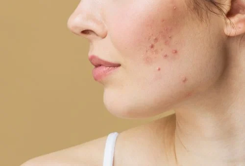 Treating-Different-Types-of-Facial-Acne-r41lo7ugltp23795lk3x0exjz2589bk2iyea30u24o