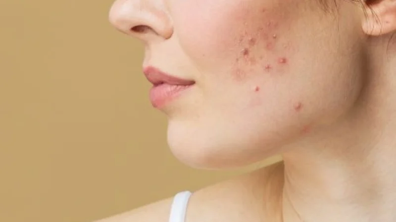 Treating-Different-Types-of-Facial-Acne-r41lo7ugltp23795lk3x0exjz2589bk2iyea30u24o