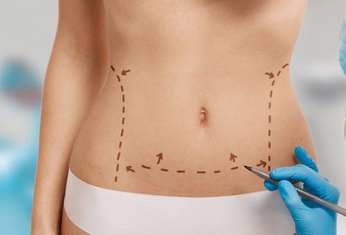 WHAT-IS-A-TUMMY-TUCK-1 WHAT-IS-A-TUMMY-TUCK-1