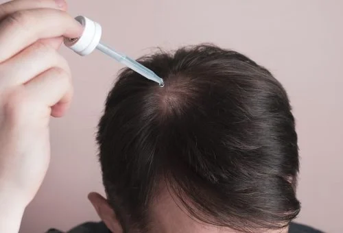 hair-loss-problem-man-applying-dropper-with-minoxidil-scaled-1-r41m94r6o4bqeuvih3k2zmxrsp28ivl2egy7hntpoo