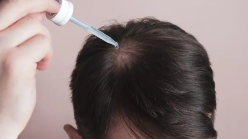 hair-loss-problem-man-applying-dropper-with-minoxidil-scaled-1-r41m94r6o4bqeuvih3k2zmxrsp28ivl2egy7hntpoo