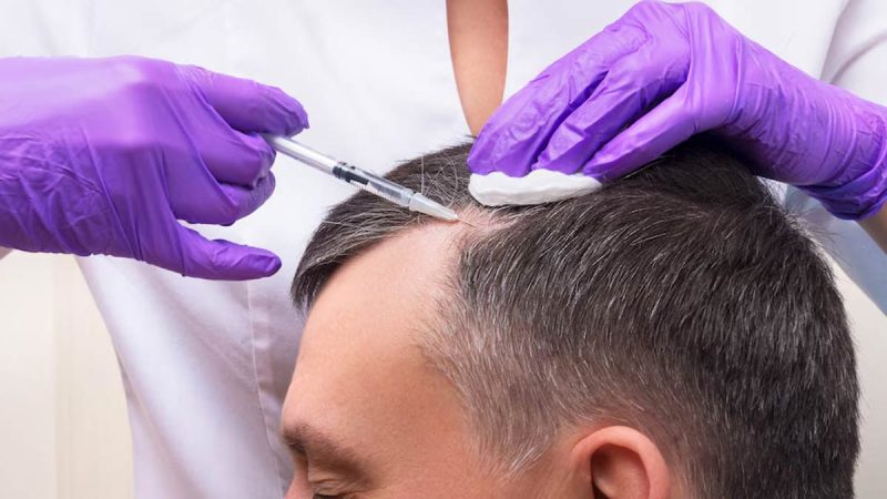 mn-hair-transplant-1740132348227 mn-hair-transplant-1740132348227