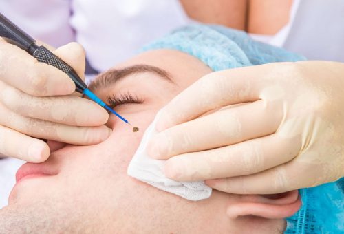 mole-removal mole-removal