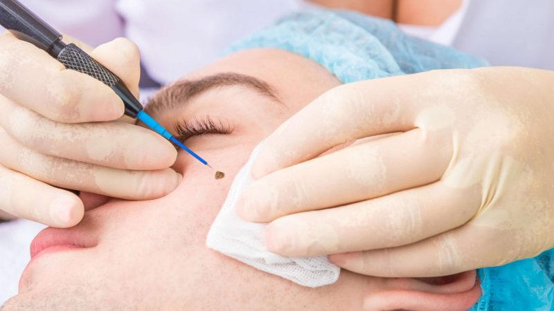 mole-removal mole-removal