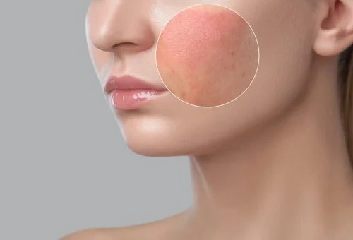 skin-inflammation-r41lmt36crrko9avty629rqnw93epnykbz6262xbgo